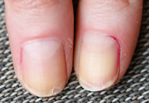 Why My Nails Are Peeling: Things You Must Know Today Why My Nails Are Peeling