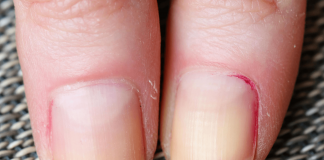 Why My Nails Are Peeling: Things You Must Know Today Why My Nails Are Peeling
