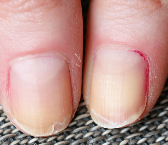 Why My Nails Are Peeling: Things You Must Know Today Why My Nails Are Peeling