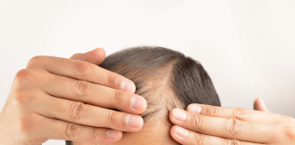 20 Best Hair Loss Treatment for men that really works hair loss treatment for men