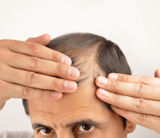 20 Best Hair Loss Treatment for men that really works hair loss treatment for men