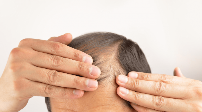 20 Best Hair Loss Treatment for men that really works hair loss treatment for men