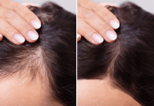 Highly Effective Hair Loss Treatment for Women hair loss treatment for women