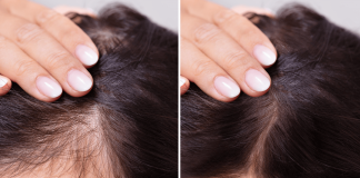 Highly Effective Hair Loss Treatment for Women hair loss treatment for women