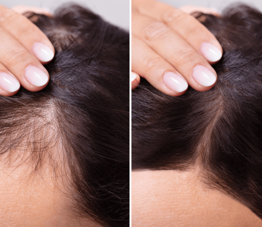 Highly Effective Hair Loss Treatment for Women hair loss treatment for women