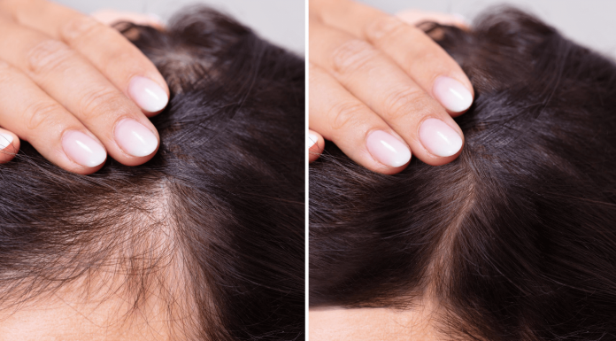 Highly Effective Hair Loss Treatment for Women hair loss treatment for women