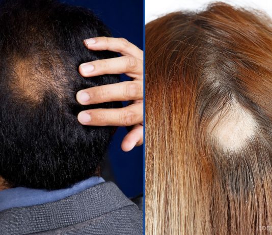 How To Cover Bald Spots With Makeup: 6 Most Effective Methods How To Cover Bald Spots With Makeup