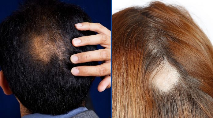 How To Cover Bald Spots With Makeup: 6 Most Effective Methods How To Cover Bald Spots With Makeup